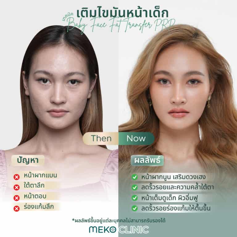 เติมไขมันหน้าเด็กช่วยอะไรบ้าง