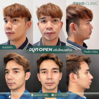 รีวิวเสริมจมูกผู้ชายเทคนิคopen-2