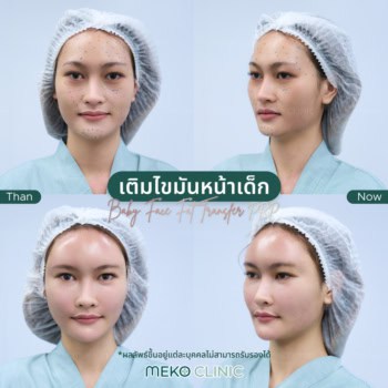 รีวิวเติมไขมันหน้าเด็ก