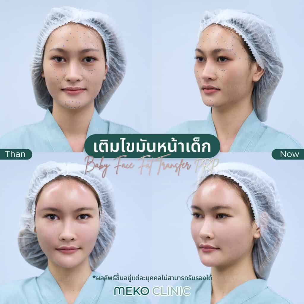 รีวิวเติมไขมันหน้าเด็ก