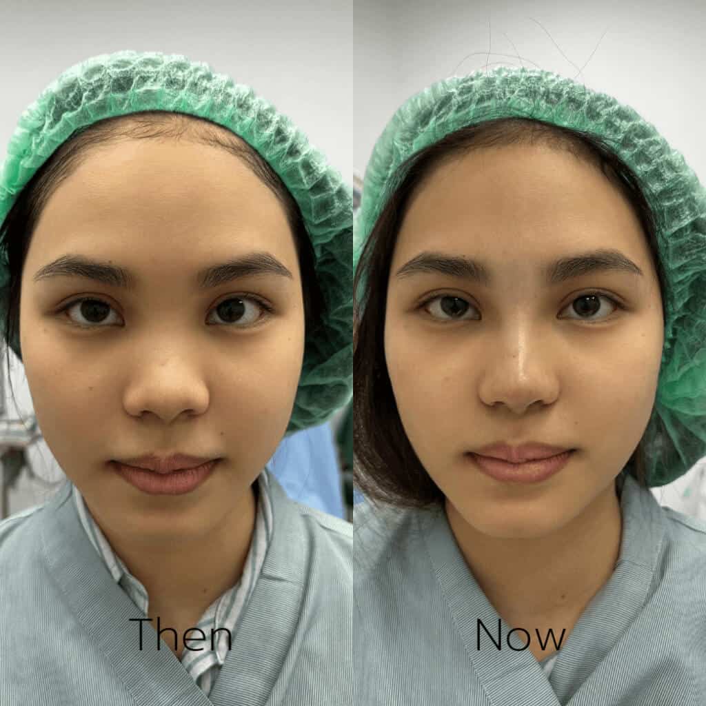 รีวิวเสริมจมูก-7-วัน-ลูกสาวหมอแพร-สวยจึ้งจนเพื่อนทัก-1