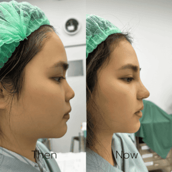 รีวิวเสริมจมูก 7 วัน (ลูกสาวหมอแพร) สวยจึ้งจนเพื่อนทัก