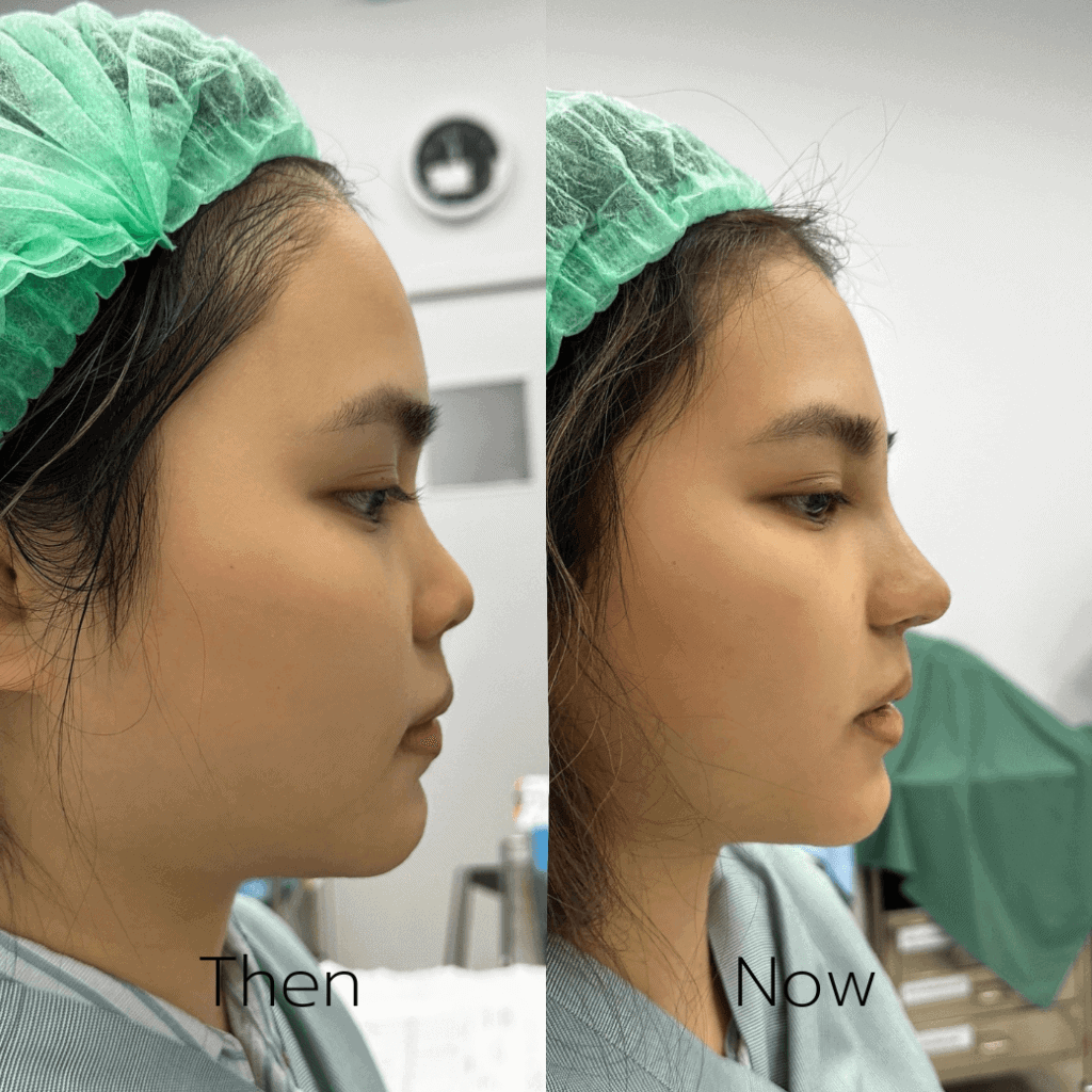 รีวิวเสริมจมูก 7 วัน (ลูกสาวหมอแพร) สวยจึ้งจนเพื่อนทัก