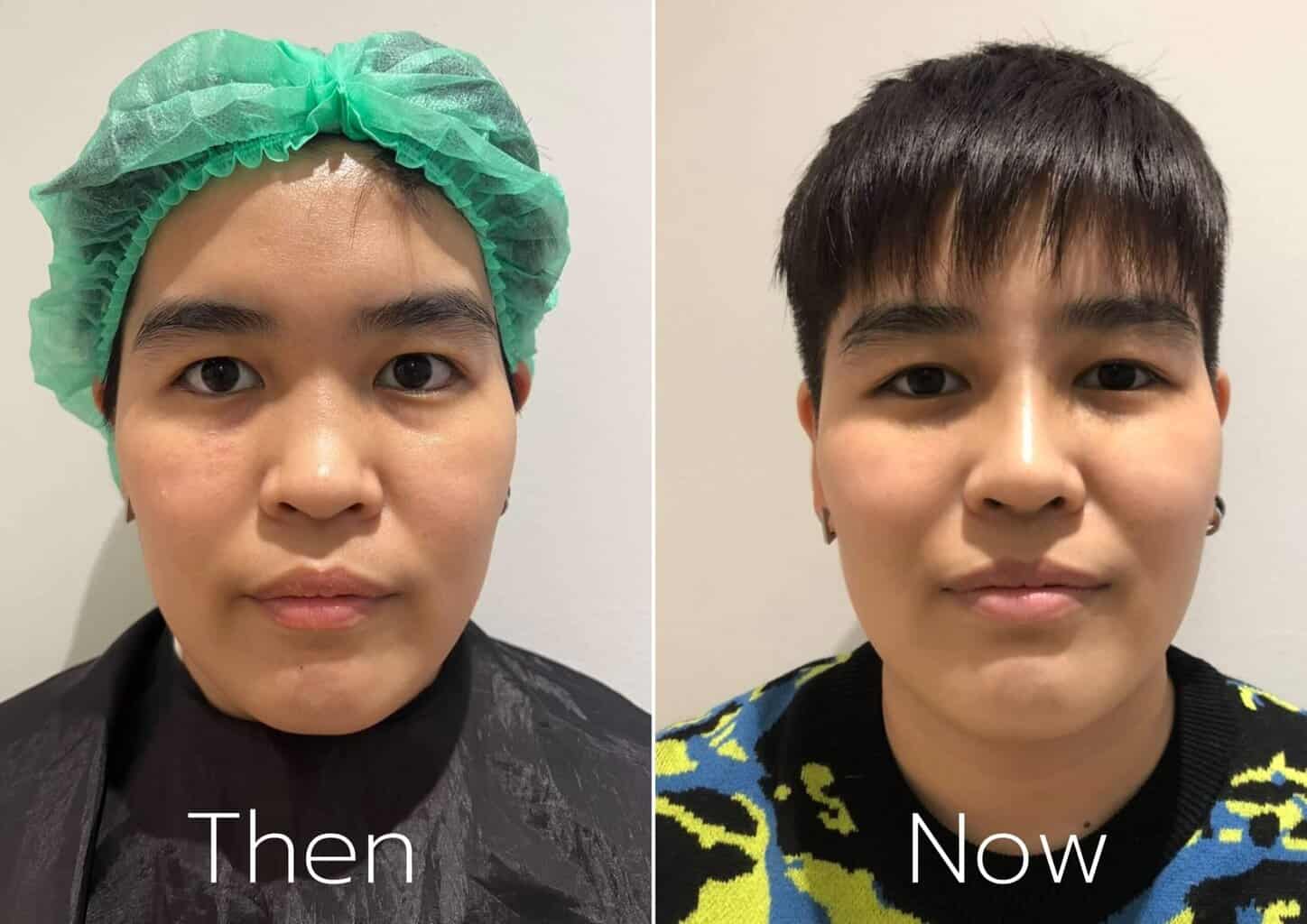 รีวิวเสริมจมูก14-วัน-ของสาวหล่อ-เนื้อน้อย