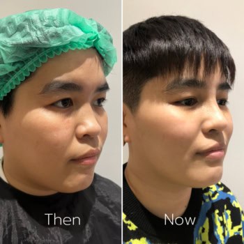 รีวิวเสริมจมูก14 วัน ของสาวหล่อ เนื้อน้อยจะออกมาเป็นยังไง