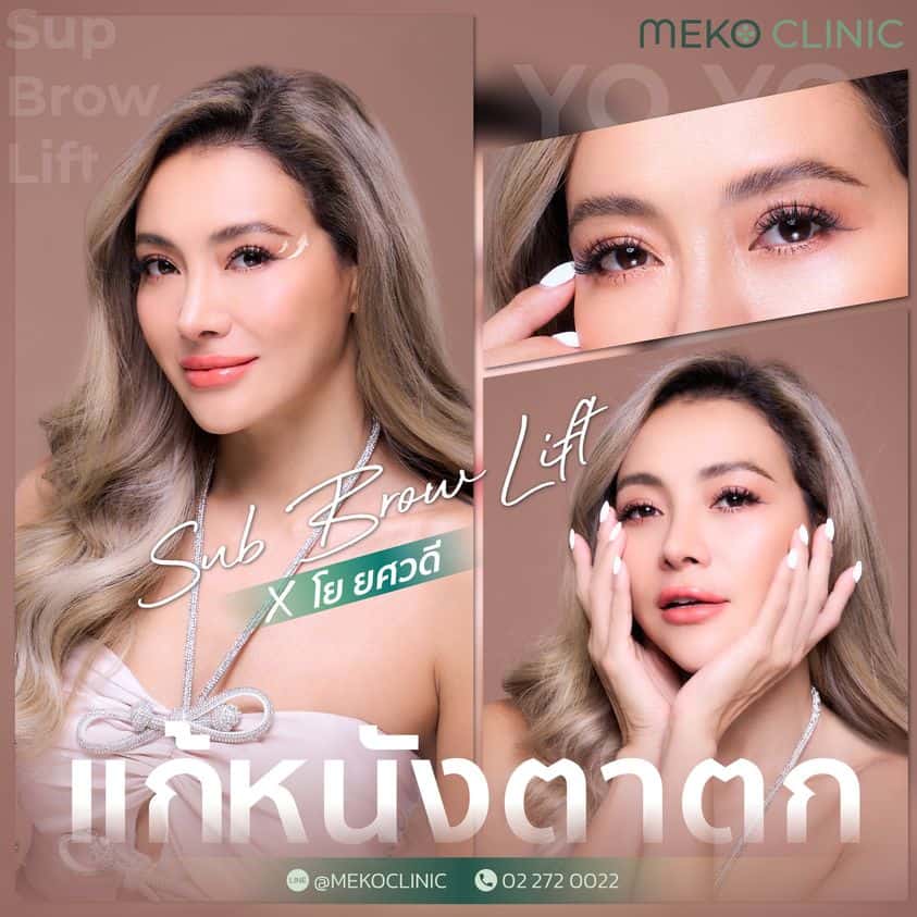 โยมั่นใจ Subbrow-lift ที่เมโกะคลินิก