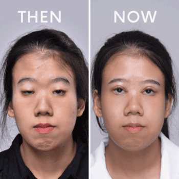 รีวิว แก้ไขกล้ามเนื้อตาอ่อนแรง รักษาโดยจักษุแพทย์