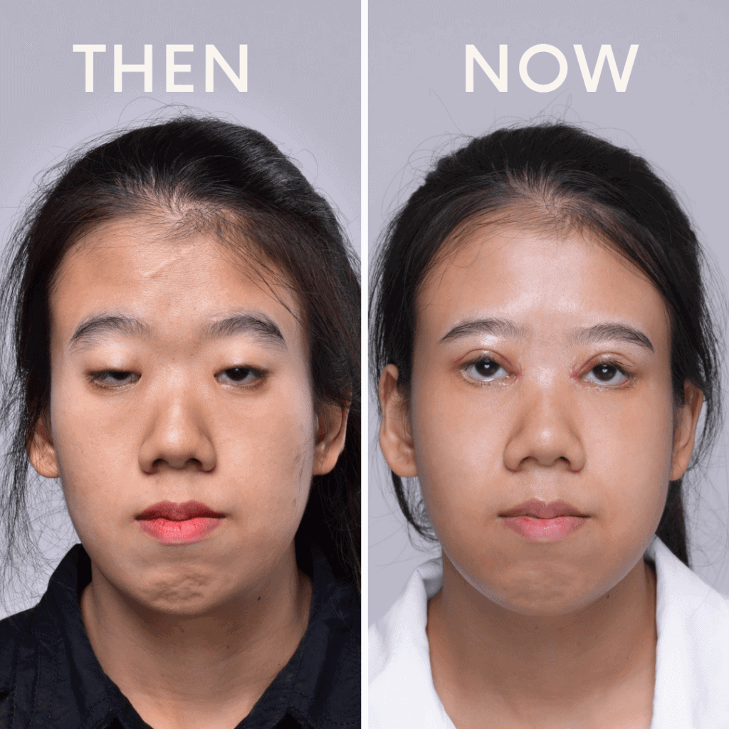 รีวิว แก้ไขกล้ามเนื้อตาอ่อนแรง รักษาโดยจักษุแพทย์