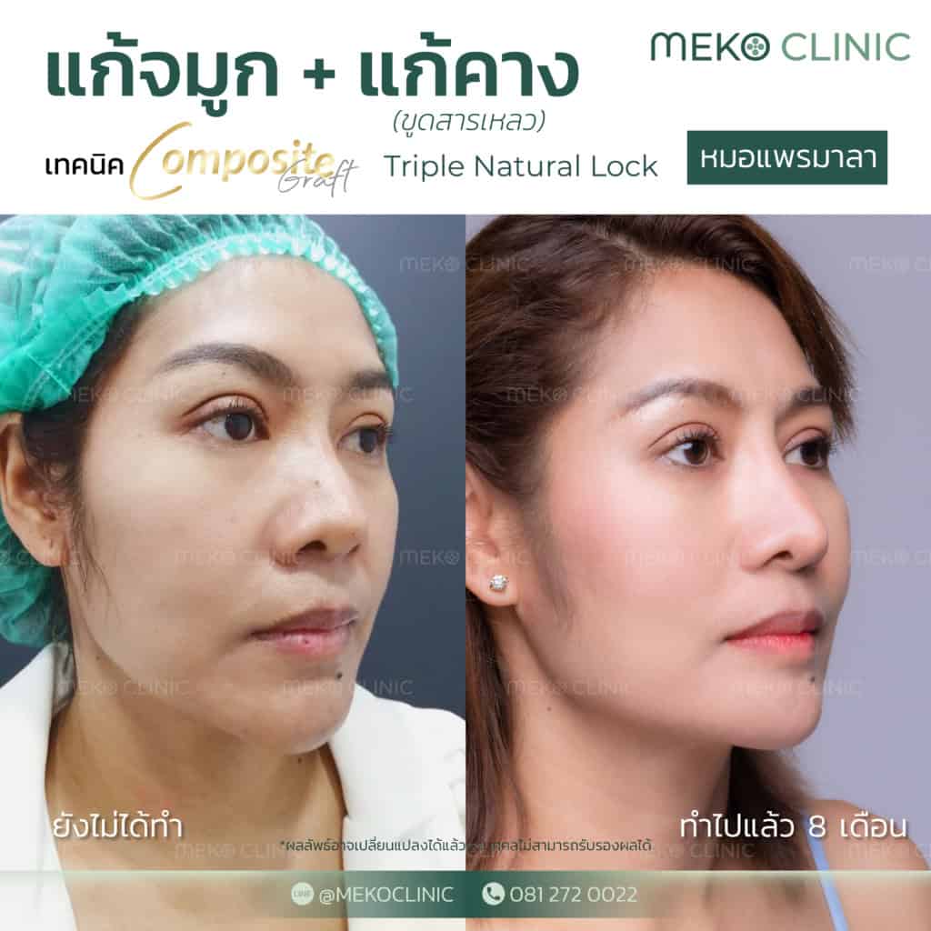 รีวิวแก้จมูกปรับโหงวเฮ้ง