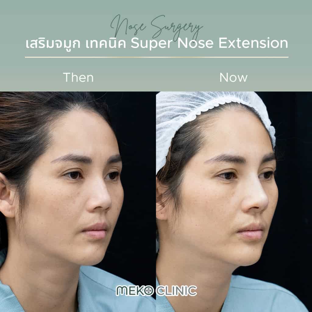 รีวิวเสริมจมูกทรงธรรมชาติ หลังทำทันที