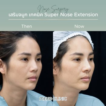 รีวิวเสริมจมูกทรงธรรมชาติ หลังทำทันที