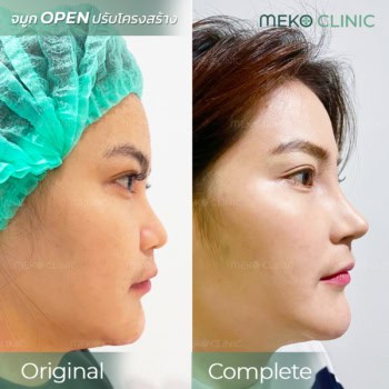 รีวิว เสริมจมูก แบบ open เทคนิคกระดูกอ่อนซี่โครง