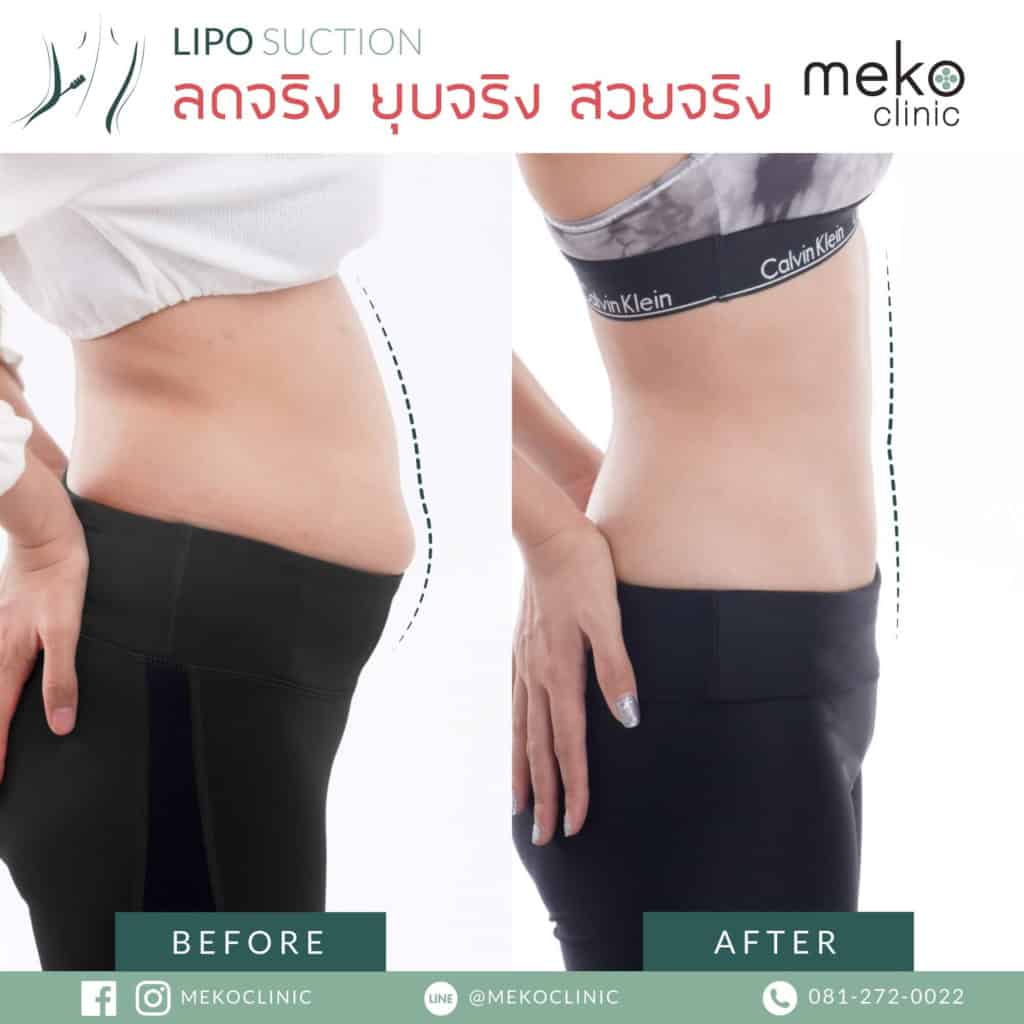 วิธีการดูดไขมันมีกี่วิธี และตำแหน่งในการดูดไขมันมีจุดไหนบ้าง