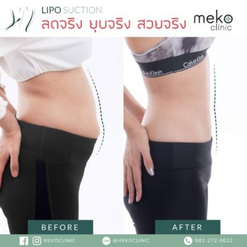 วิธีการดูดไขมันมีกี่วิธี และตำแหน่งในการดูดไขมันมีจุดไหนบ้าง