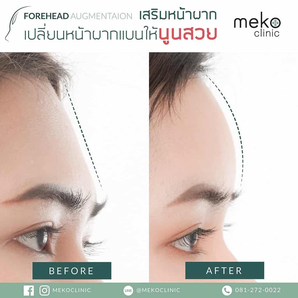 เสริมหน้าผากด้วยซิลิโคนสำเร็จรูป