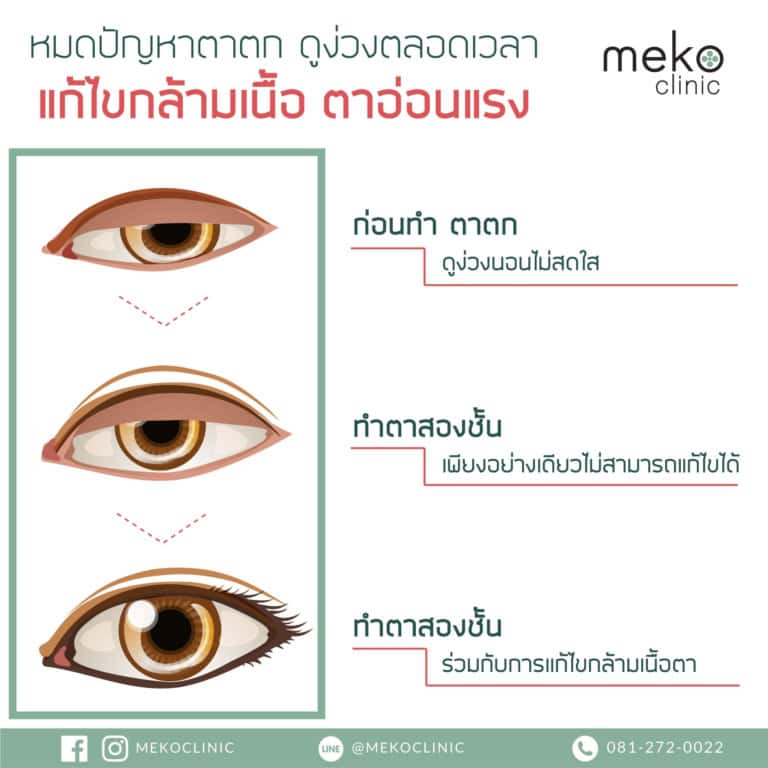 ตาปรือ ตาตก ชั้นตาไม่เท่ากัน จบทุกปัญหาที่เมโกะ คลินิก