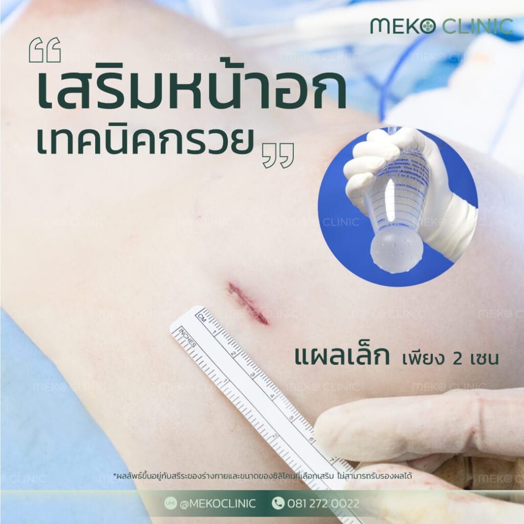 เสริมหน้าอกเทคนิคกรวย