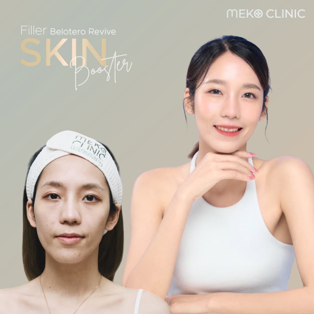ยืนหนึ่งในเรื่องของผิวใส Belotero Revive ฟิลเลอร์งานผิว