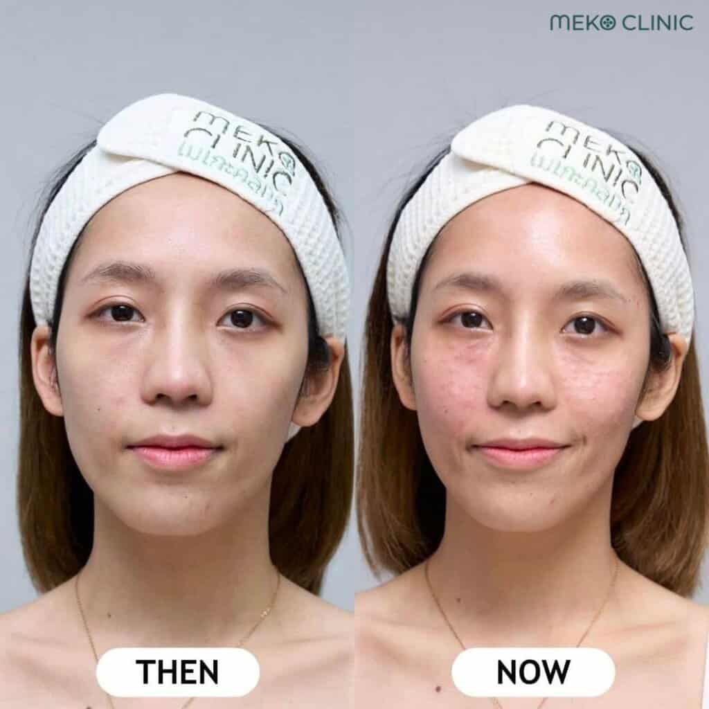 ยืนหนึ่งในเรื่องของผิวใส Belotero Revive ฟิลเลอร์งานผิว-5