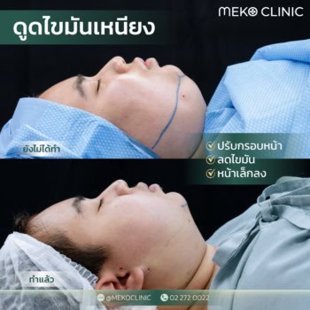 รีวิวดูดไขมันเหนียง + ดูดไขมันกรอบหน้า