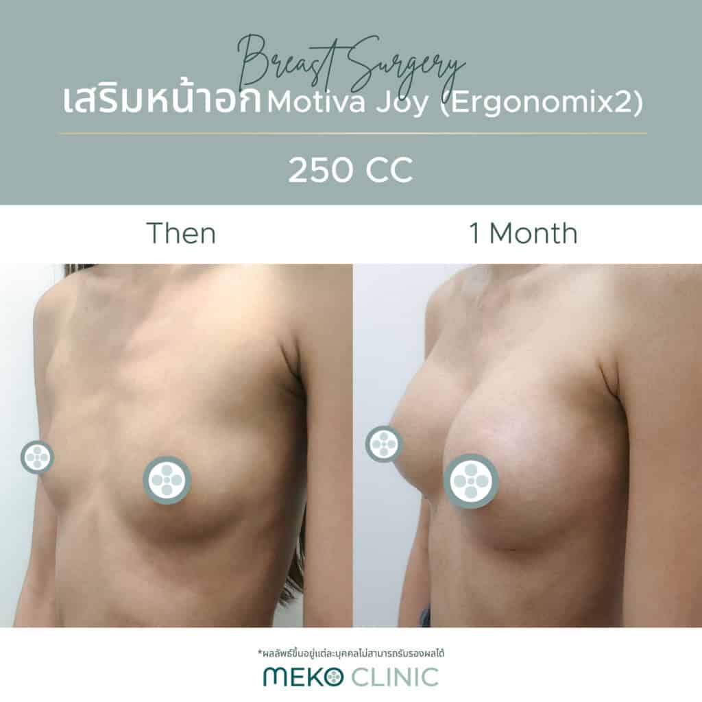 ลูกค้า ณัชศร ชิดชลธาร Before _ After Breast Surgery-03