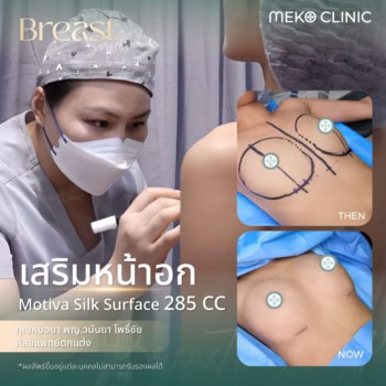 banner-เสริมหน้าอก-Review-motiva-01