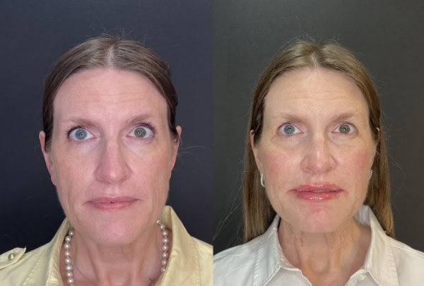 เติมฟิลเลอร์ปรับรูปหน้า ที่ เมโกะ คลินิก รีเควสคุณหมอมิ้ว-2