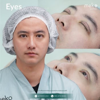 บิ๊ก ภูชิสะ แก้ไขโรคกล้ามเนื้อตาอ่อนแรง