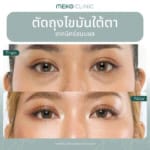 รีวิวตัดถุงใต้ตา ไม่มีรอยแผล ของคนอายุน้อย