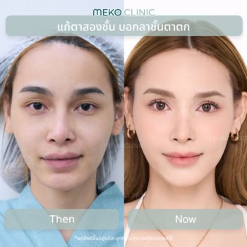 คุณน้ำขิง เคยทำตาที่เกาหลีมาแล้วไม่ปลื้ม อยากแก้ชั้นตาที่ตกและไม่เท่ากันให้กลับมาโค้งชัด เส้นคม