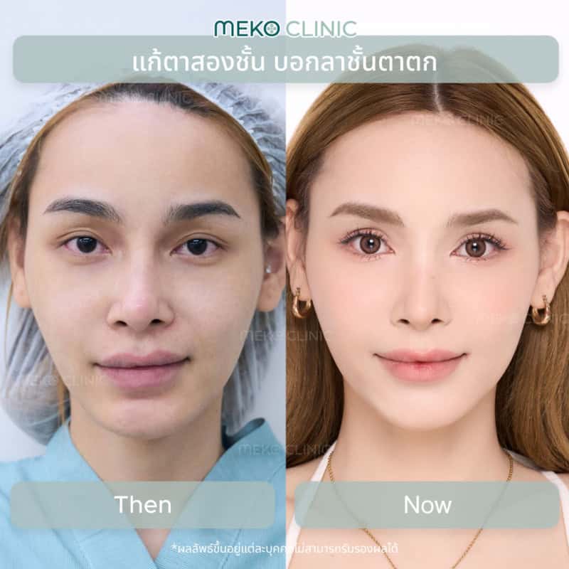 คุณน้ำขิง เคยทำตาที่เกาหลีมาแล้วไม่ปลื้ม อยากแก้ชั้นตาที่ตกและไม่เท่ากันให้กลับมาโค้งชัด เส้นคม