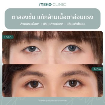 สาวหมวยต้องดู! รีวิวแก้ปัญหาตาไม่เท่ากัน