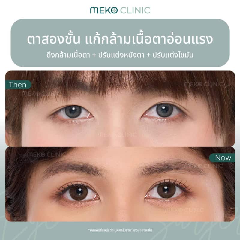 สาวหมวยต้องดู! รีวิวแก้ปัญหาตาไม่เท่ากัน