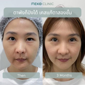 ตาพังก็ปังได้ เคสแก้ตาสองชั้น