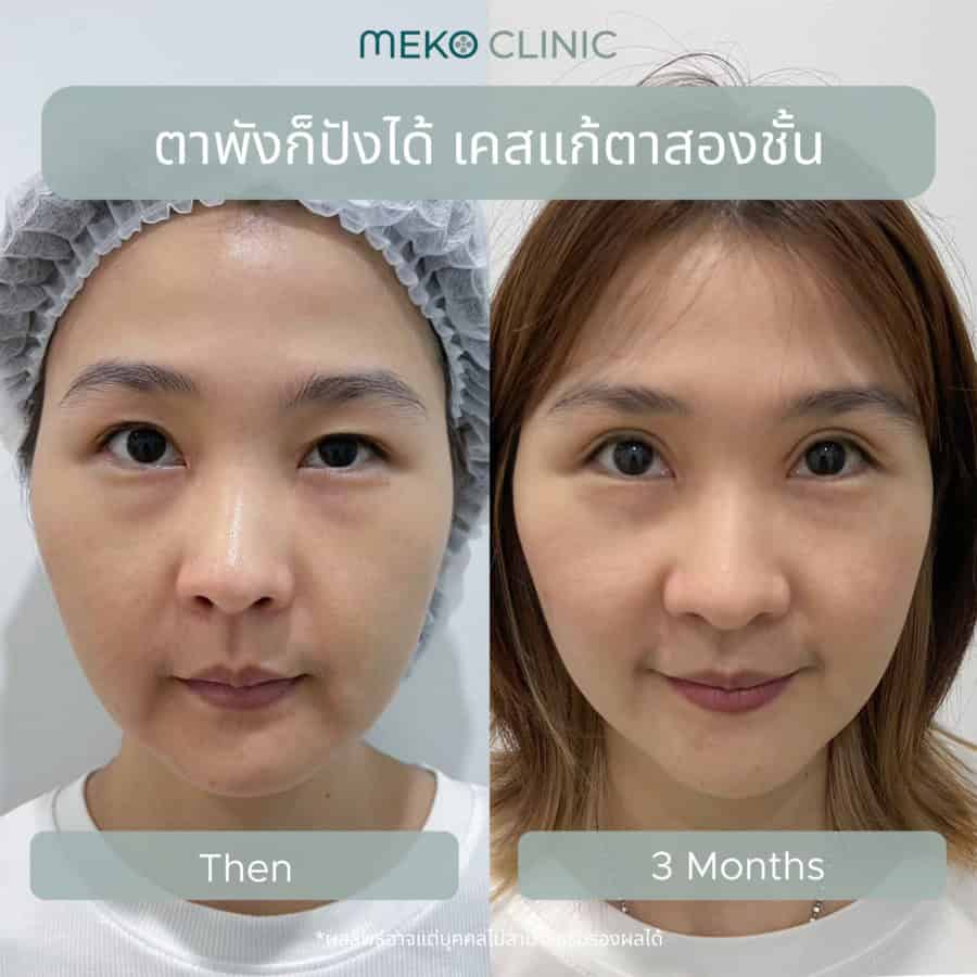 ตาพังก็ปังได้ เคสแก้ตาสองชั้น