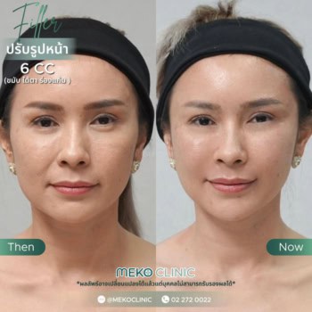 รีวิวเติมฟิลเลอร์ปรับรูปหน้า 6 CC กับหมอทินน์