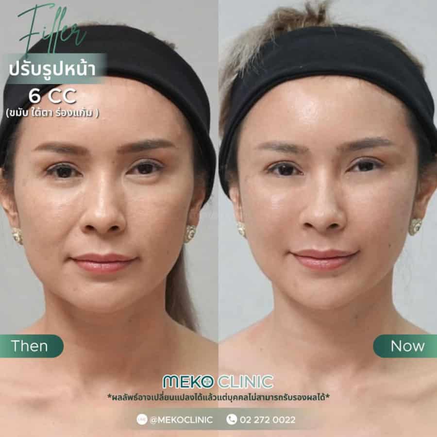 รีวิวเติมฟิลเลอร์ปรับรูปหน้า 6 CC กับหมอทินน์