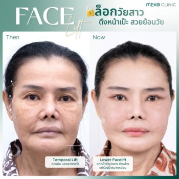 Face lift รีวิวดึงหน้าแม่โตโต้