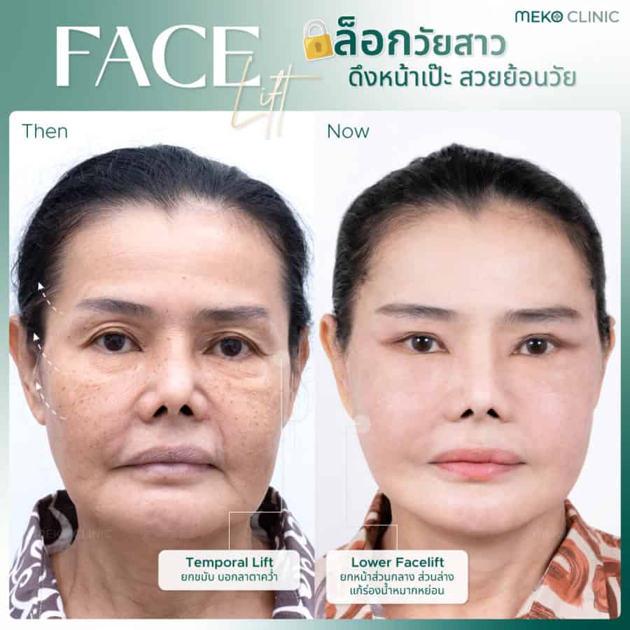 Face lift รีวิวดึงหน้าแม่โตโต้