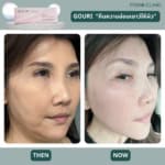 รีวิวฉีด Gouri เมโกะ คลินิก-3