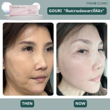 รีวิวฉีด Gouri เมโกะ คลินิก-3