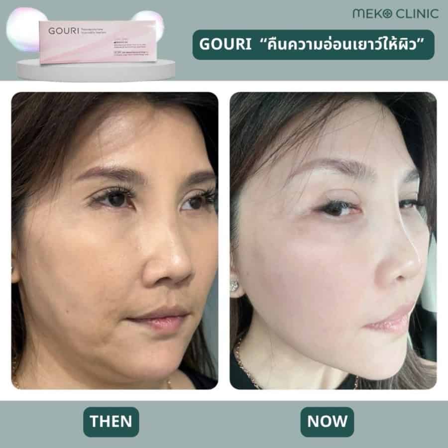 รีวิวฉีด Gouri เมโกะ คลินิก-3