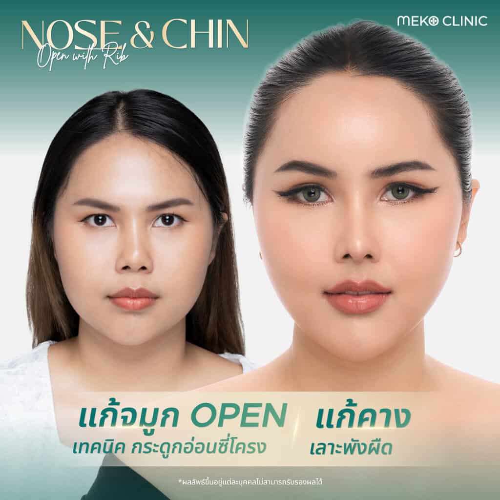 แก้จมูกโอเพ่นเทคนิคกระดูกอ่อนซี่โครง + แก้คางซิลิโคนขายาว-2