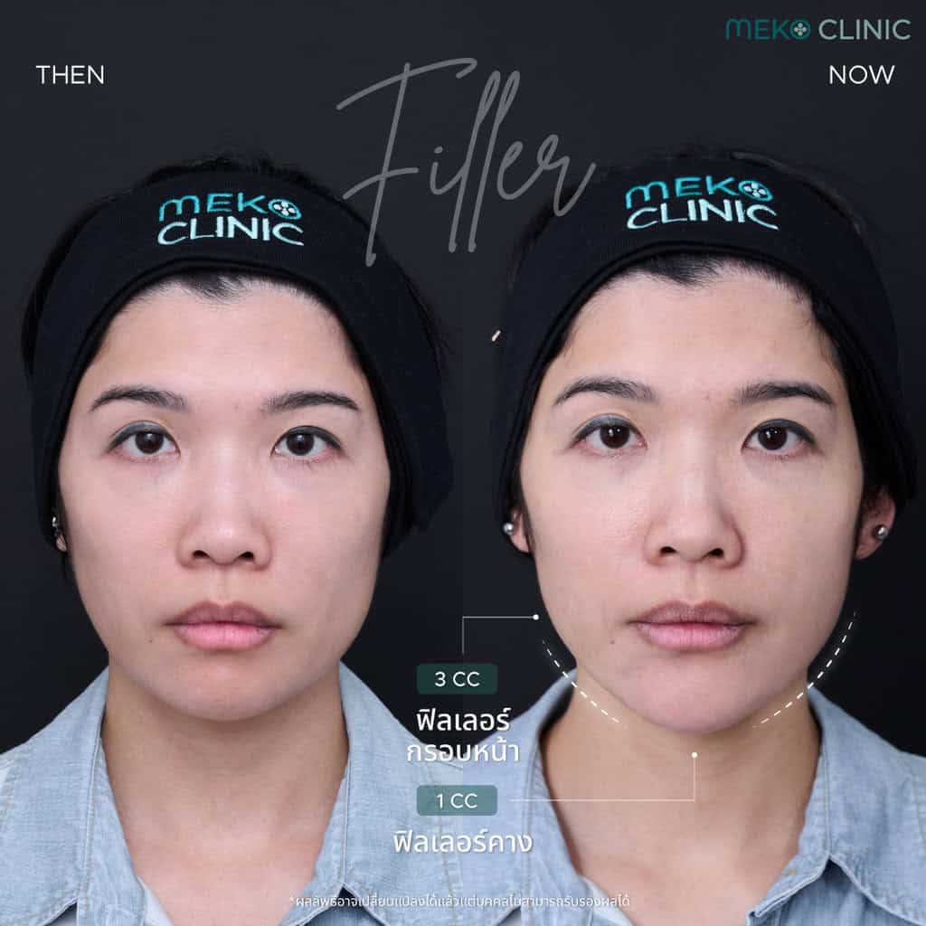 Filler-Juvederm-Chin-Jawline-หมอแพร