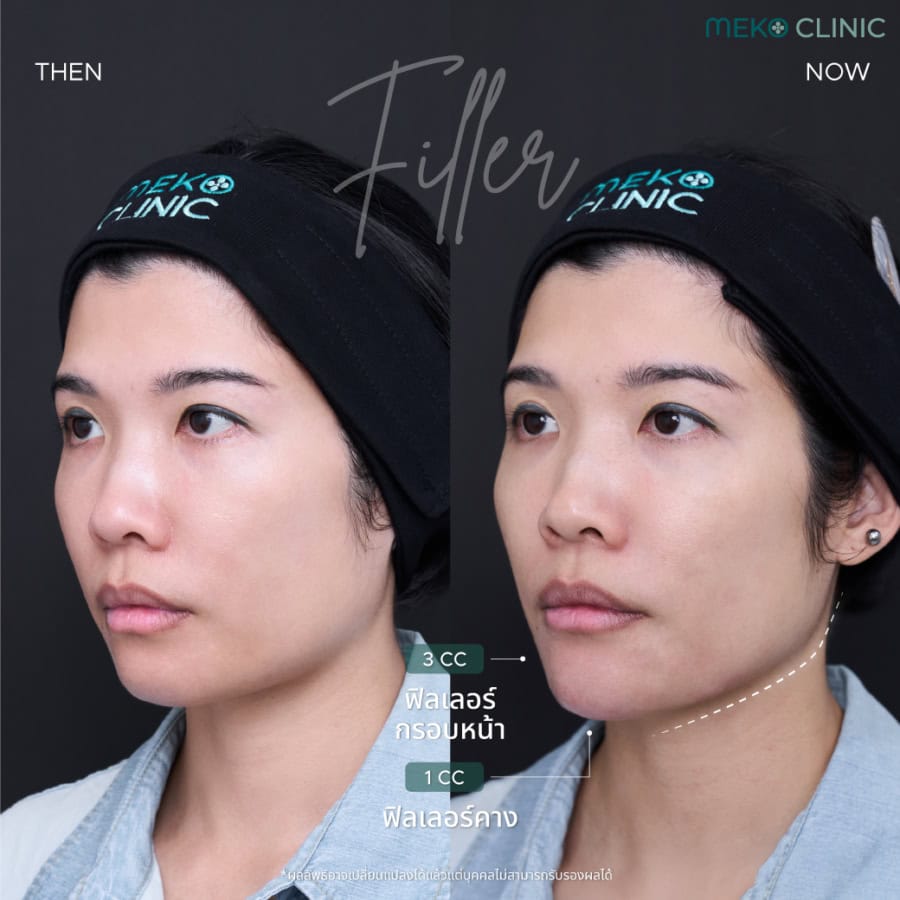Filler-Juvederm-Chin-Jawline-หมอแพร-3