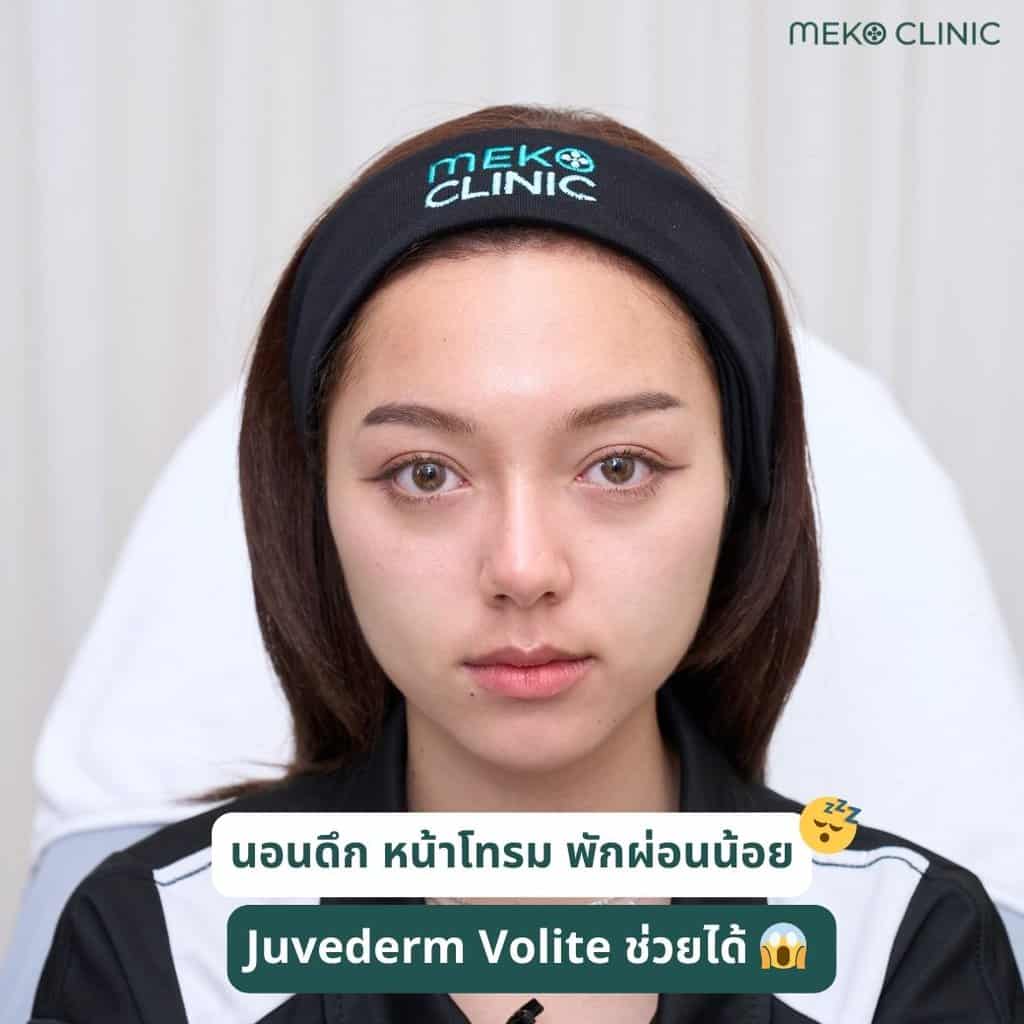 นอนดึกหน้าโทรม พักผ่อนน้อย Juvederm Volite ช่วยได้