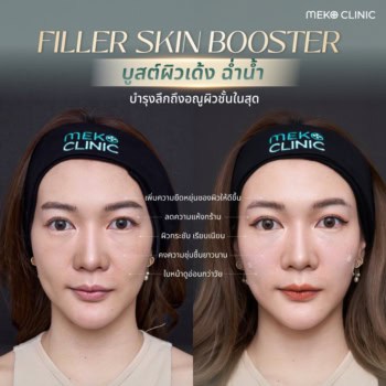 รีวิวฉีดฟิลเลอร์เมโกะ คลินิก-2