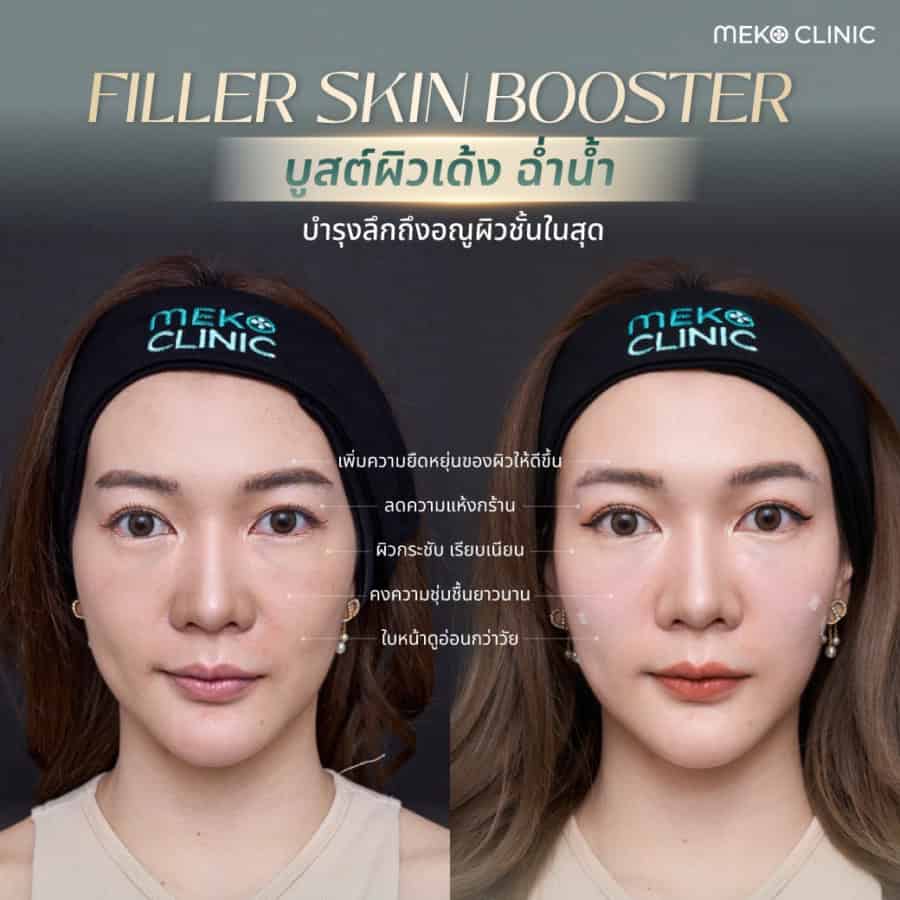 รีวิวฉีดฟิลเลอร์เมโกะ คลินิก-2