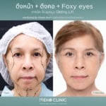 ดึงหน้าเทคนิค Gliding Brow Lift (ดึงหน้าเทคนิคใยแมงมุม) 1 เดือน