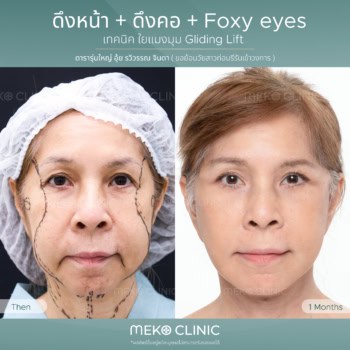 ดึงหน้าเทคนิค Gliding Brow Lift (ดึงหน้าเทคนิคใยแมงมุม) 1 เดือน